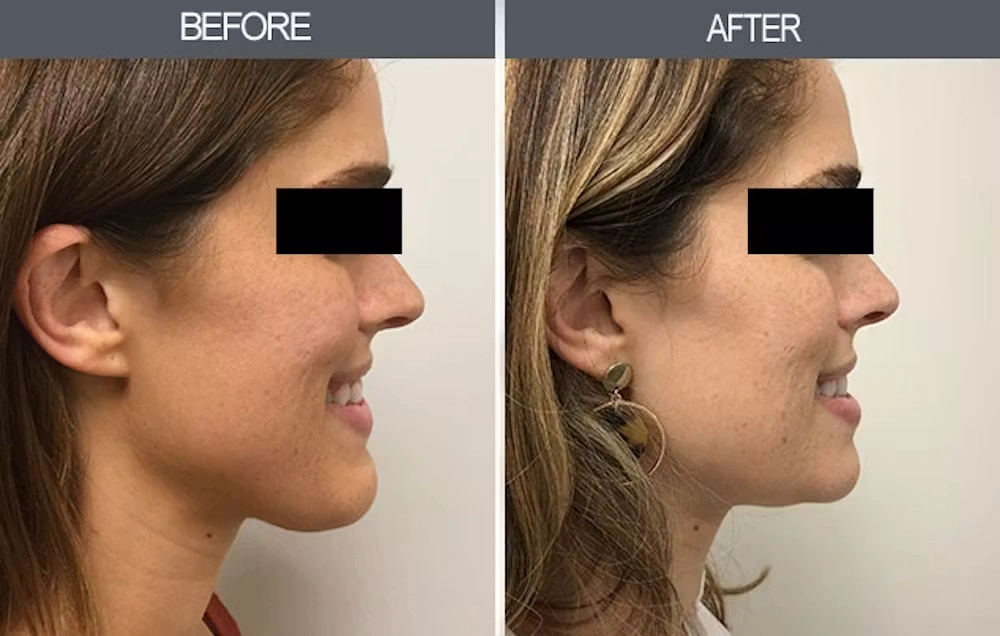 Real patient results in New York, NY Performed by Darrick E. Antell MD, FACS