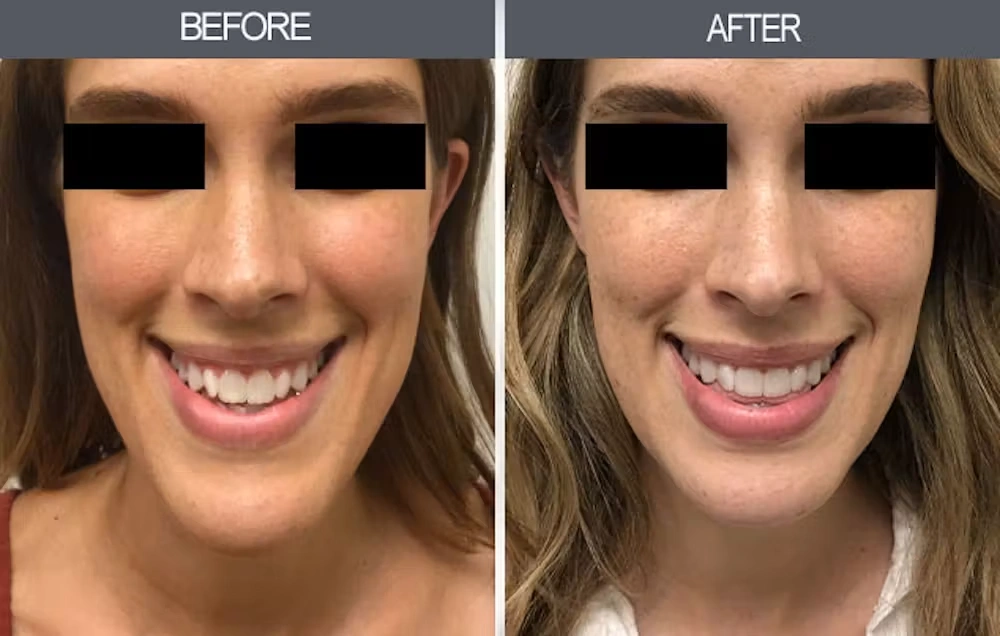 Real patient results in New York, NY Performed by Darrick E. Antell MD, FACS