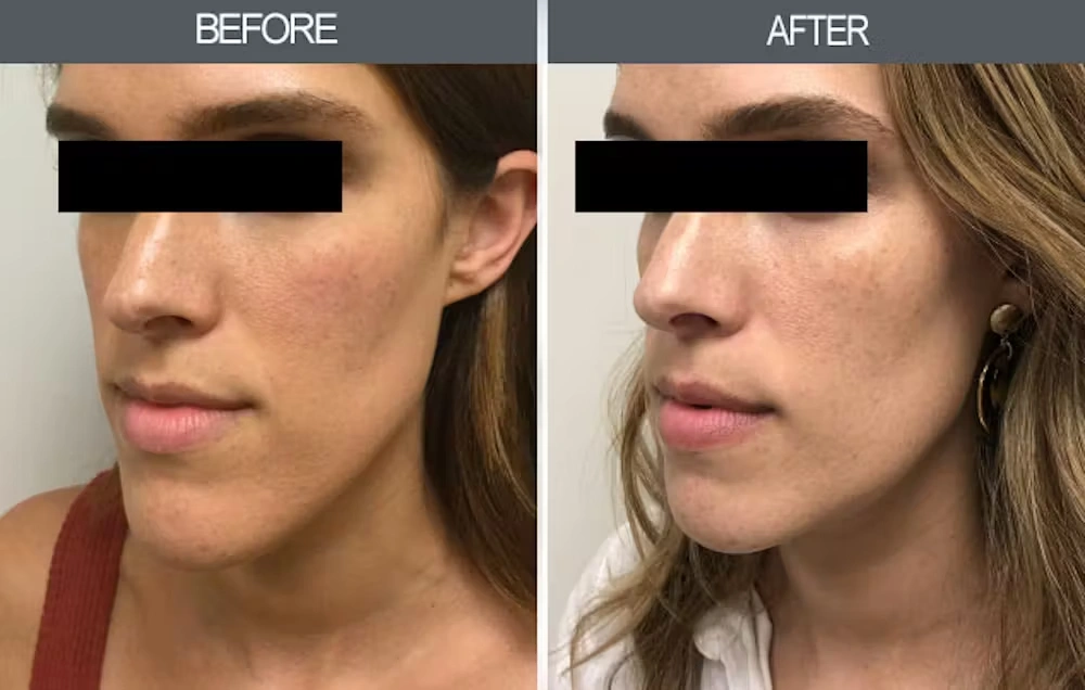 Real patient results in New York, NY Performed by Darrick E. Antell MD, FACS