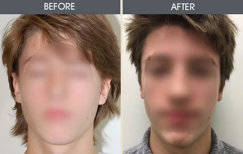 Real patient results in New York, NY Performed by Darrick E. Antell MD, FACS