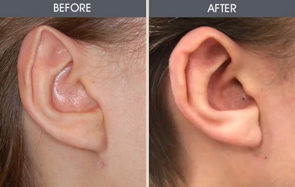 Real patient results in New York, NY Performed by Darrick E. Antell MD, FACS