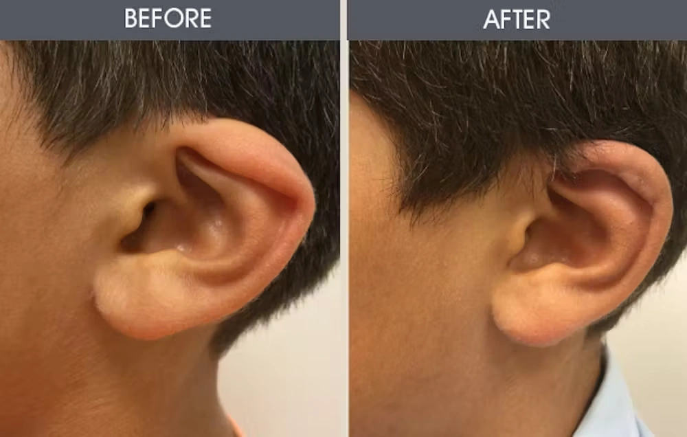 Real patient results in New York, NY Performed by Darrick E. Antell MD, FACS