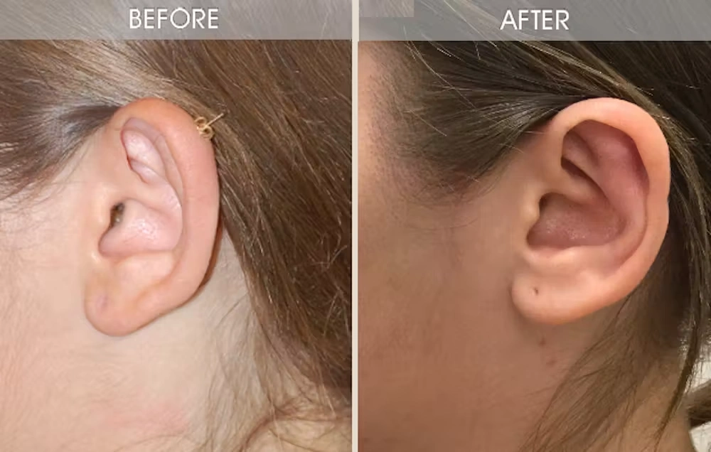 Real patient results in New York, NY Performed by Darrick E. Antell MD, FACS