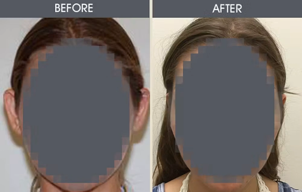Real patient results in New York, NY Performed by Darrick E. Antell MD, FACS