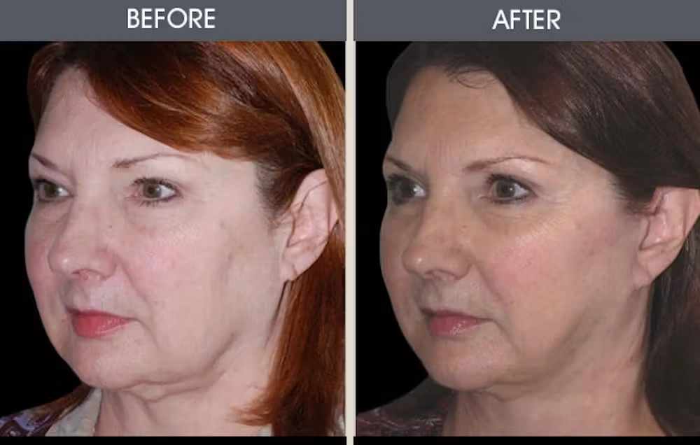 Real patient results in New York, NY Performed by Darrick E. Antell MD, FACS