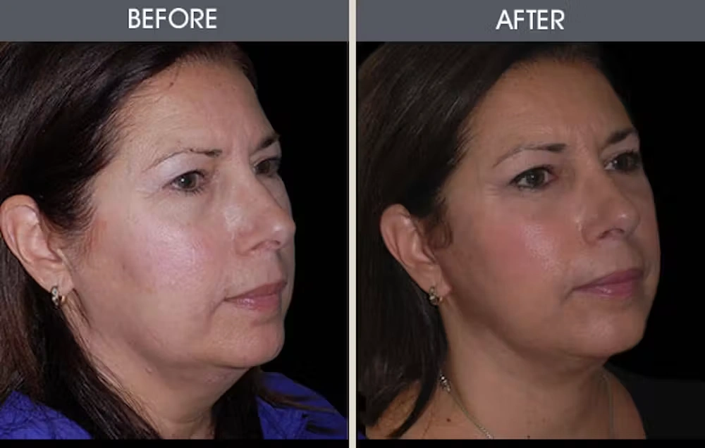 Real patient results in New York, NY Performed by Darrick E. Antell MD, FACS