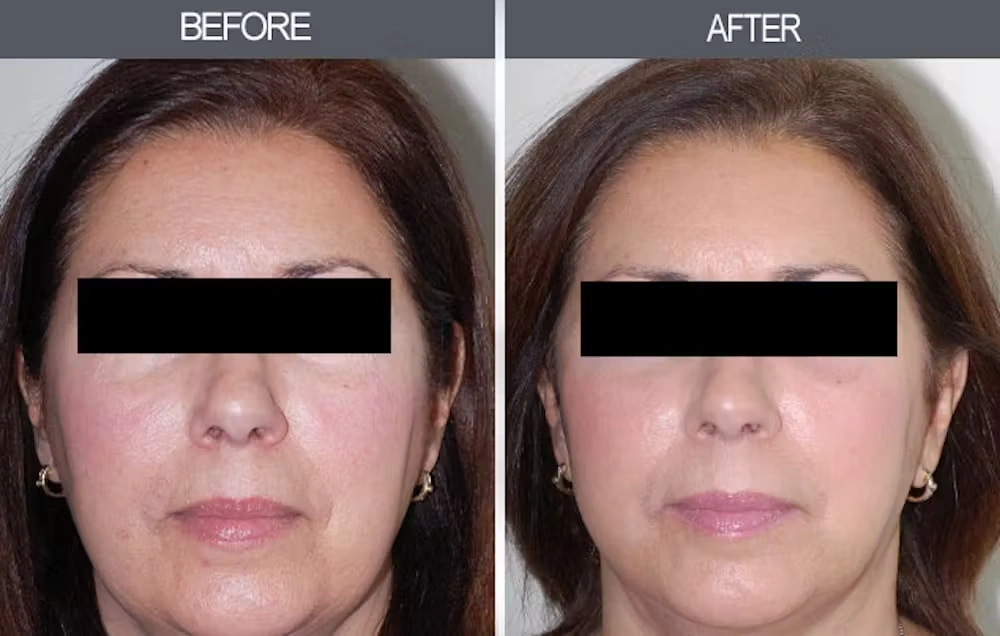 Real patient results in New York, NY Performed by Darrick E. Antell MD, FACS