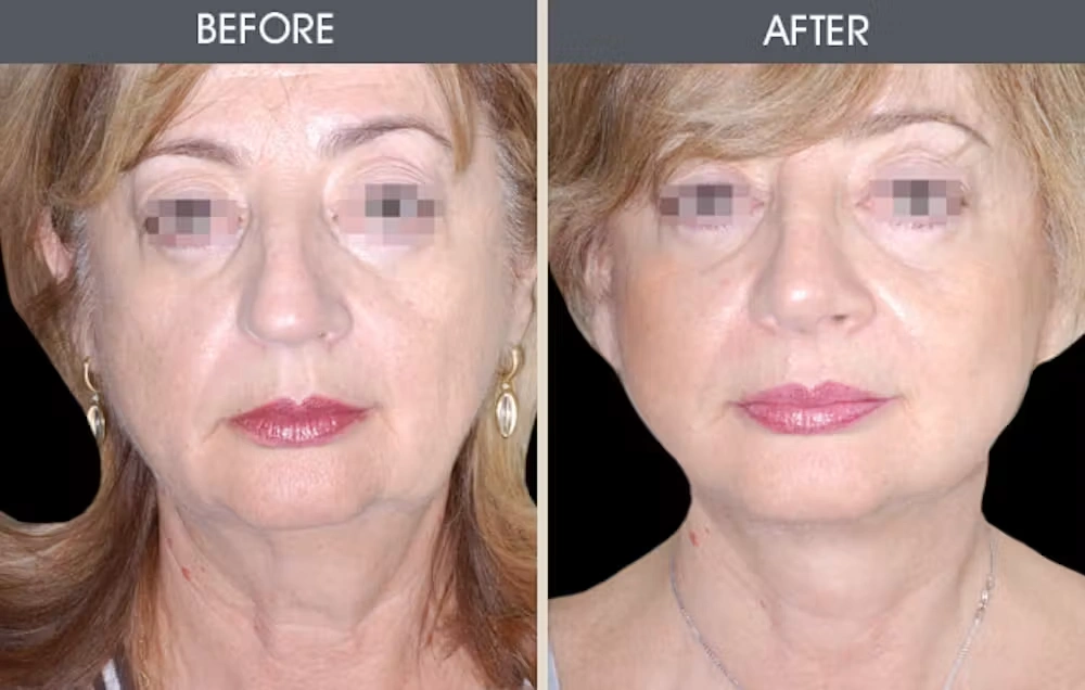 Real patient results in New York, NY Performed by Darrick E. Antell MD, FACS