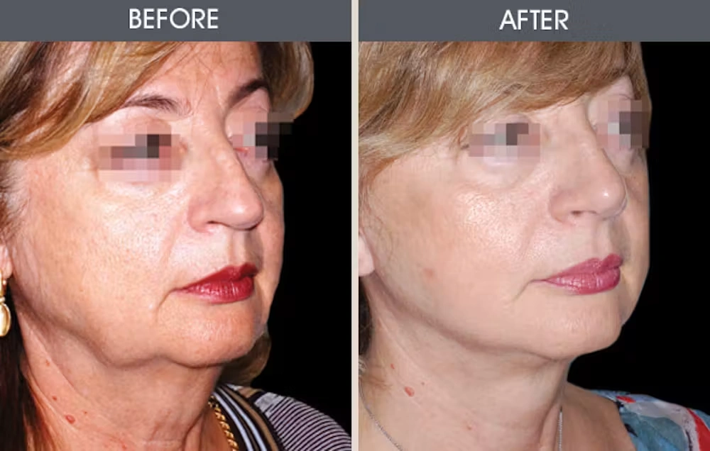 Real patient results in New York, NY Performed by Darrick E. Antell MD, FACS