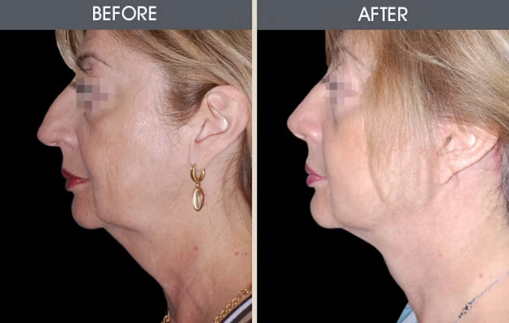 Real patient results in New York, NY Performed by Darrick E. Antell MD, FACS
