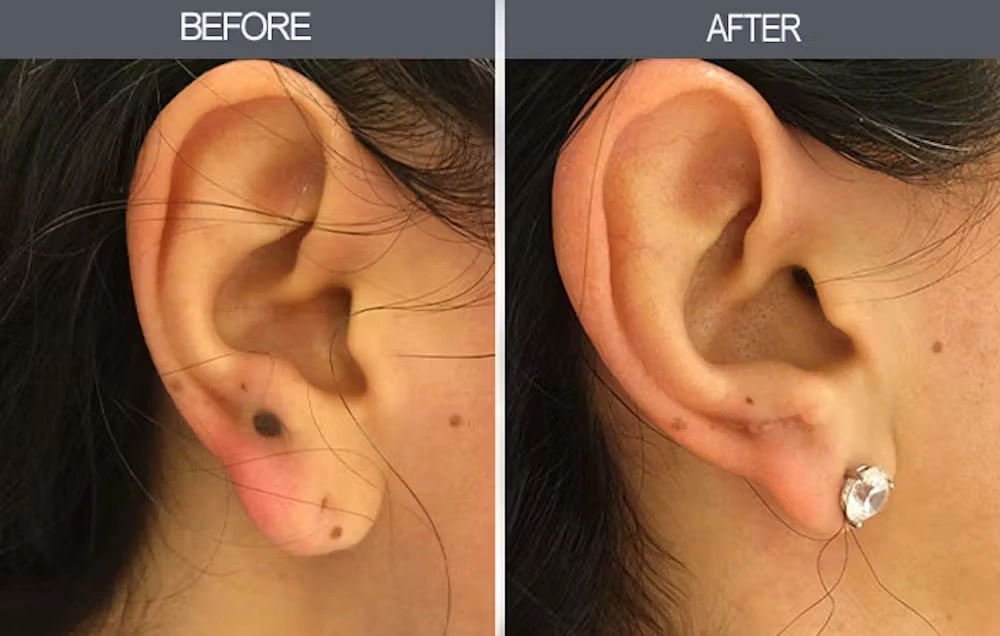 Real patient results in New York, NY Performed by Darrick E. Antell MD, FACS