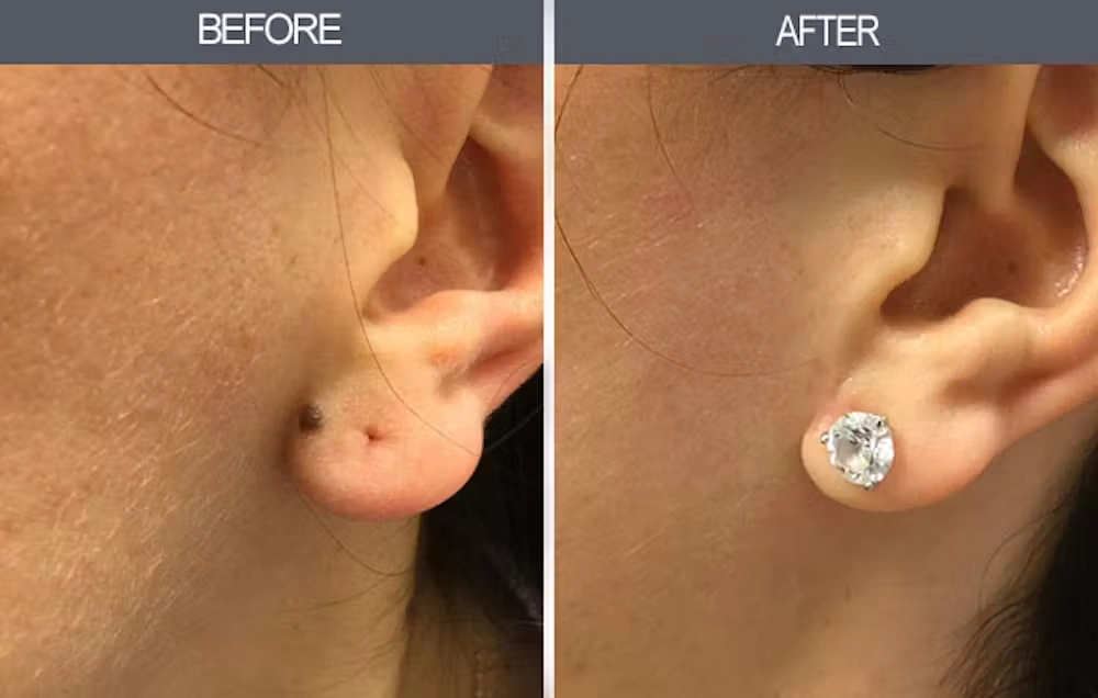 Real patient results in New York, NY Performed by Darrick E. Antell MD, FACS