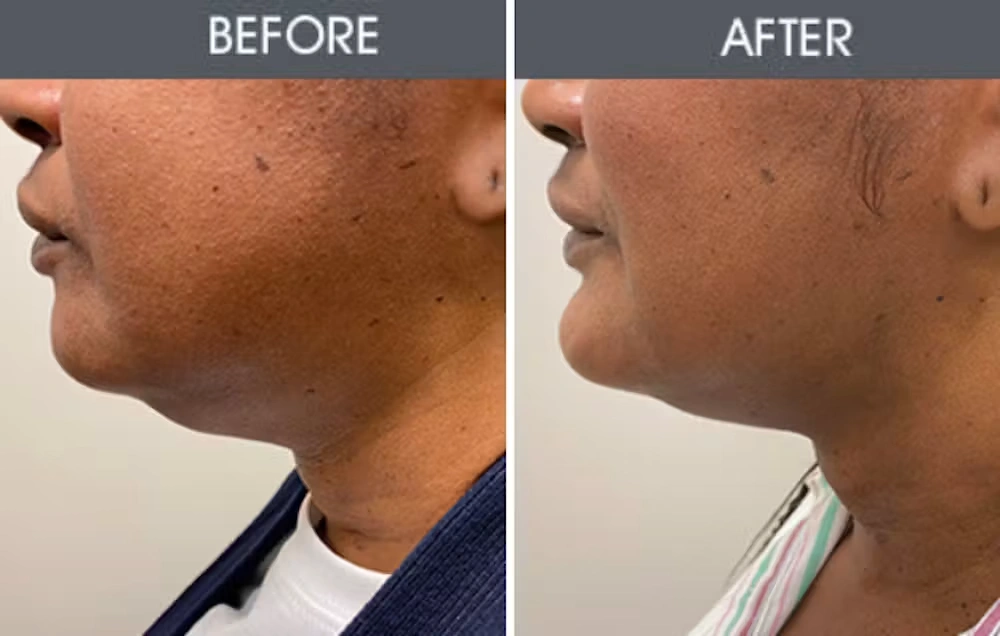 Real patient results in New York, NY Performed by Darrick E. Antell MD, FACS