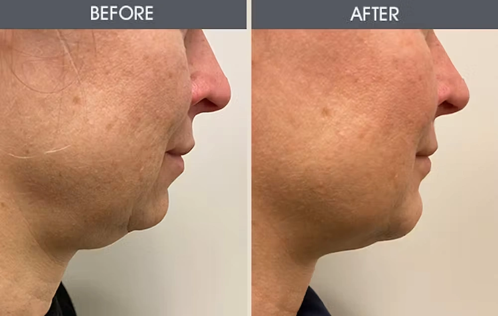 Real patient results in New York, NY Performed by Darrick E. Antell MD, FACS