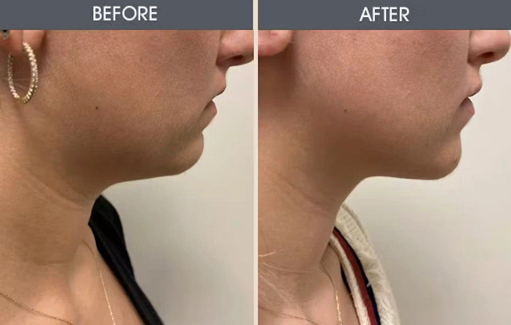 Real patient results in New York, NY Performed by Darrick E. Antell MD, FACS