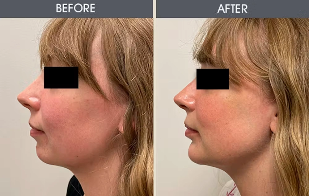 Real patient results in New York, NY Performed by Darrick E. Antell MD, FACS