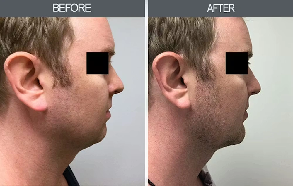 Real patient results in New York, NY Performed by Darrick E. Antell MD, FACS