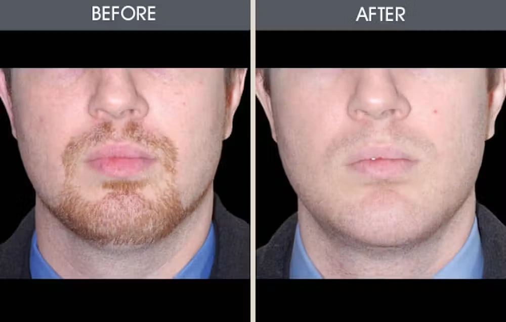 Real patient results in New York, NY Performed by Darrick E. Antell MD, FACS