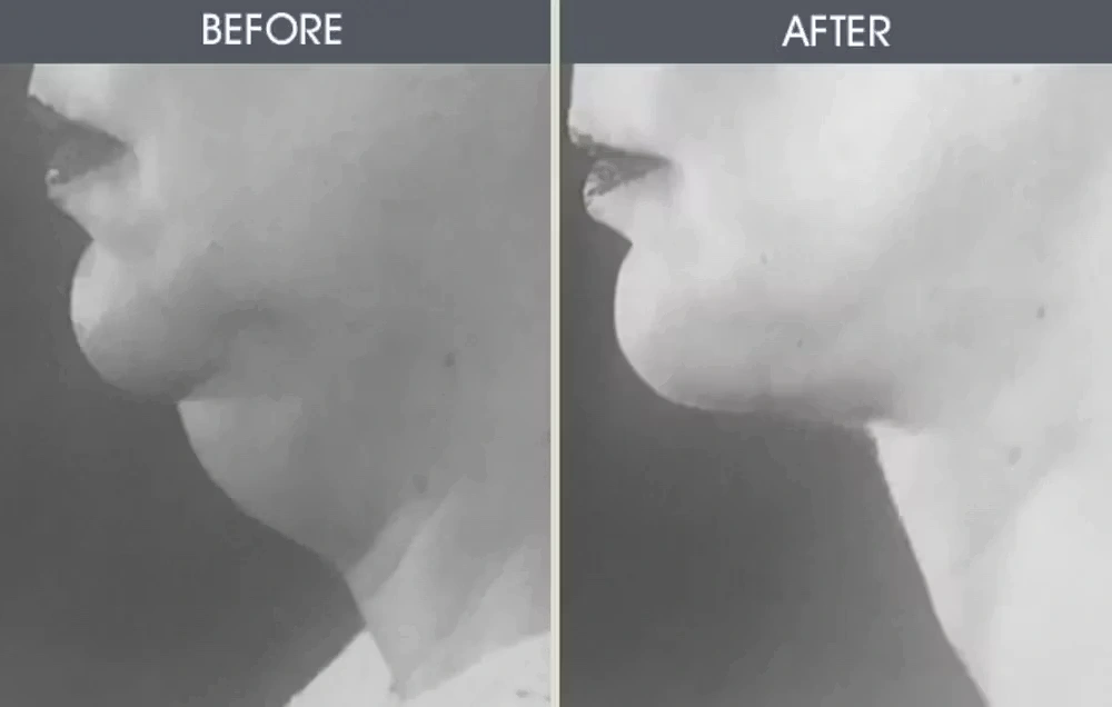 Real patient results in New York, NY Performed by Darrick E. Antell MD, FACS