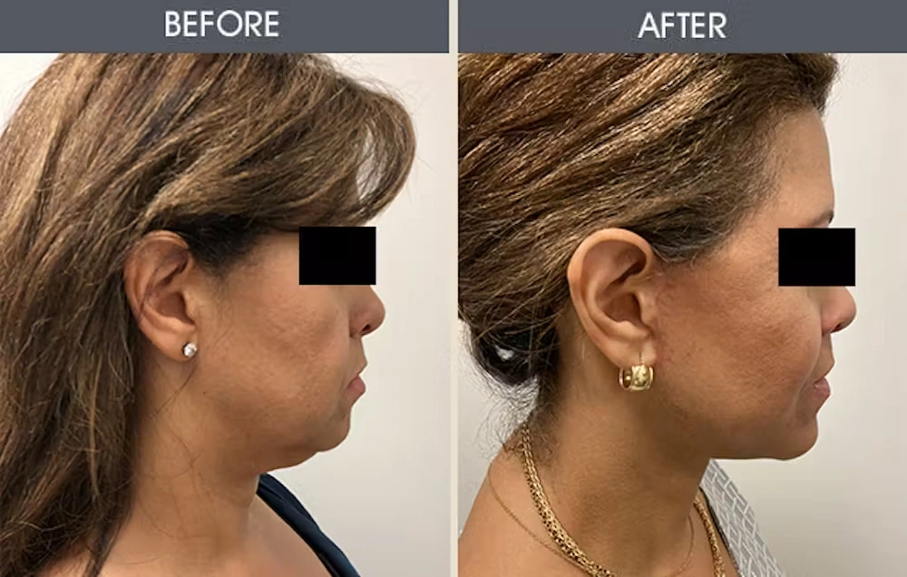 Real patient results in New York, NY Performed by Darrick E. Antell MD, FACS