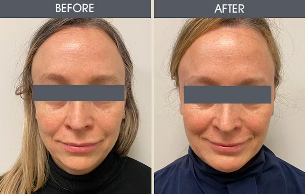 Real patient results in New York, NY Performed by Darrick E. Antell MD, FACS