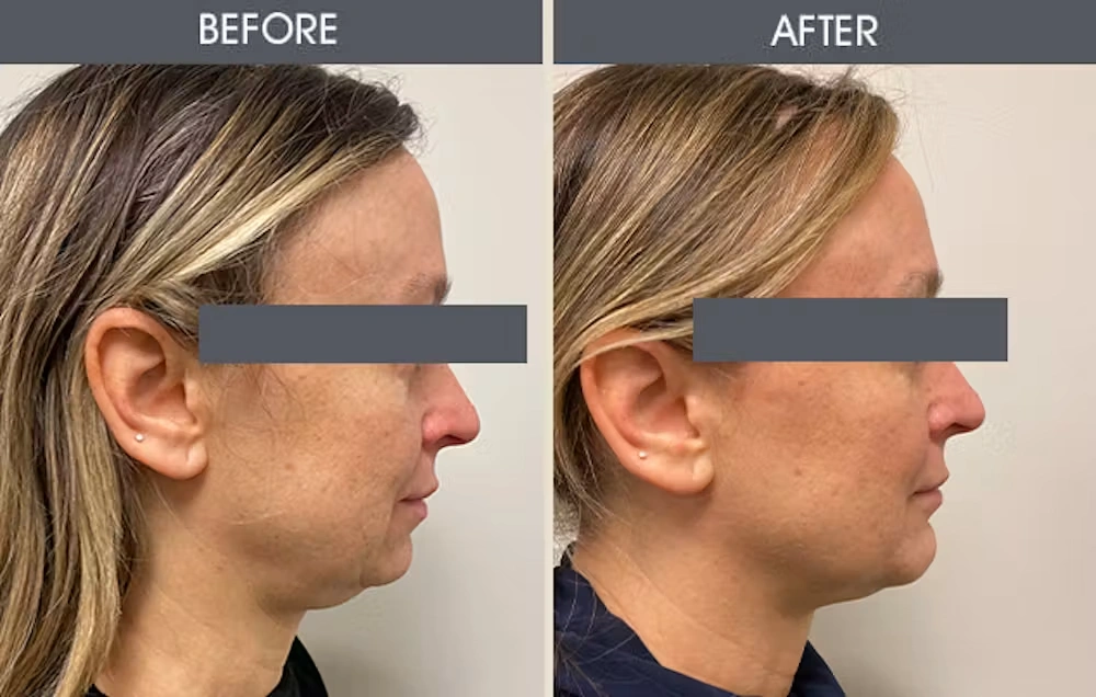 Real patient results in New York, NY Performed by Darrick E. Antell MD, FACS