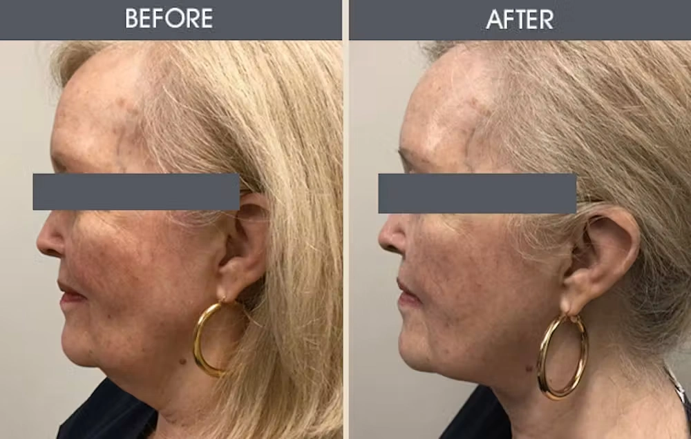 Real patient results in New York, NY Performed by Darrick E. Antell MD, FACS