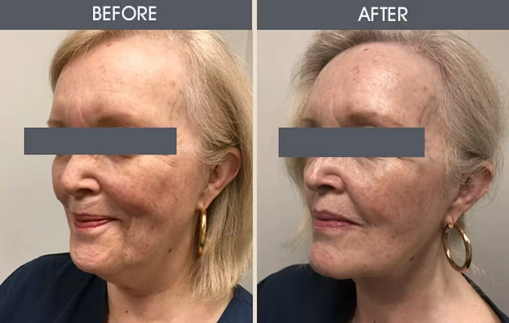 Real patient results in New York, NY Performed by Darrick E. Antell MD, FACS