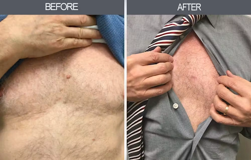 Real patient results in New York, NY Performed by Darrick E. Antell MD, FACS