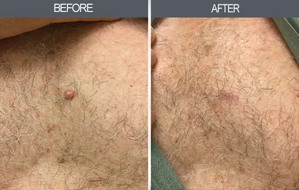 Real patient results in New York, NY Performed by Darrick E. Antell MD, FACS
