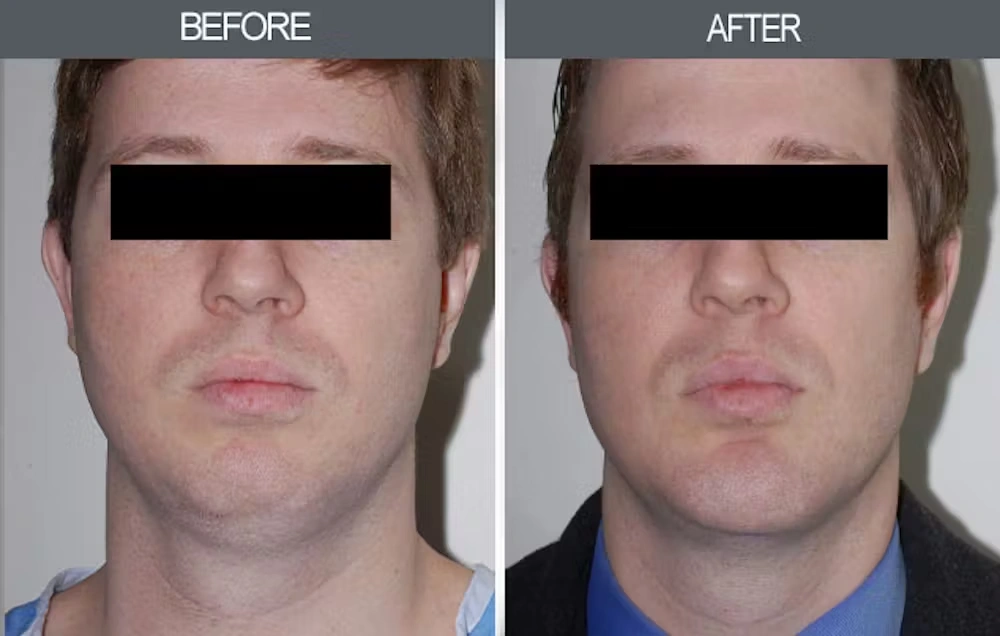 Real patient results in New York, NY Performed by Darrick E. Antell MD, FACS