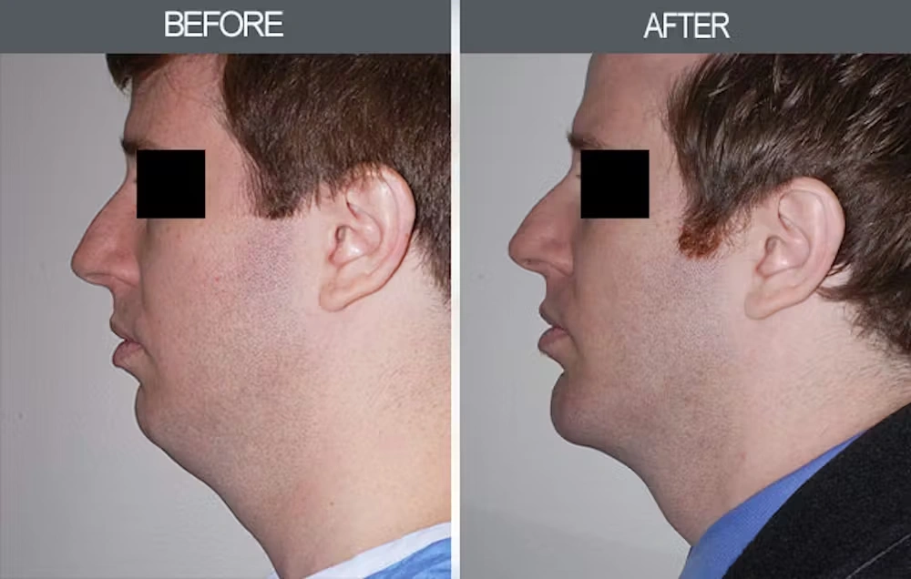 Real patient results in New York, NY Performed by Darrick E. Antell MD, FACS