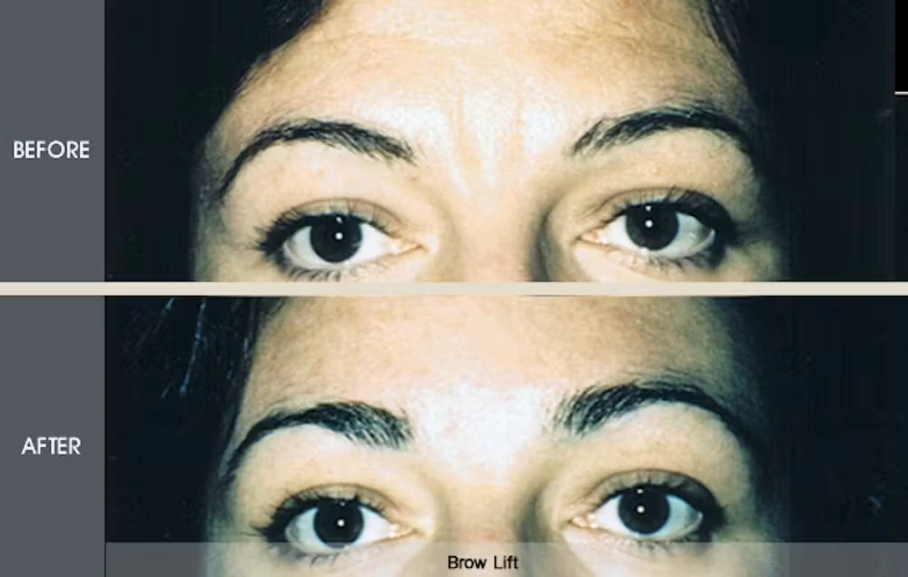 Real patient results in New York, NY Performed by Darrick E. Antell MD, FACS