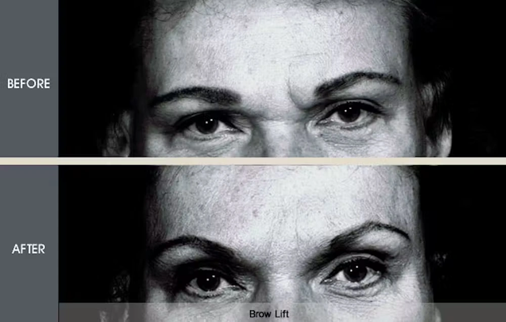 Real patient results in New York, NY Performed by Darrick E. Antell MD, FACS