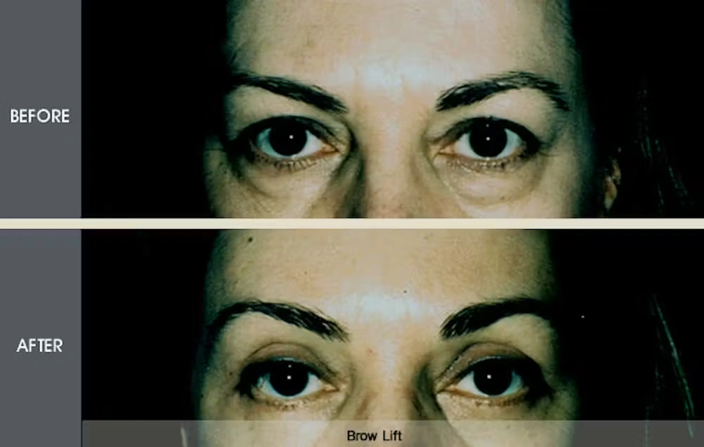 Real patient results in New York, NY Performed by Darrick E. Antell MD, FACS