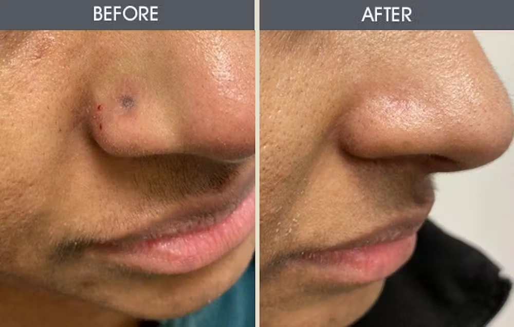Real patient results in New York, NY Performed by Darrick E. Antell MD, FACS