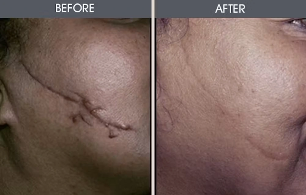 Real patient results in New York, NY Performed by Darrick E. Antell MD, FACS