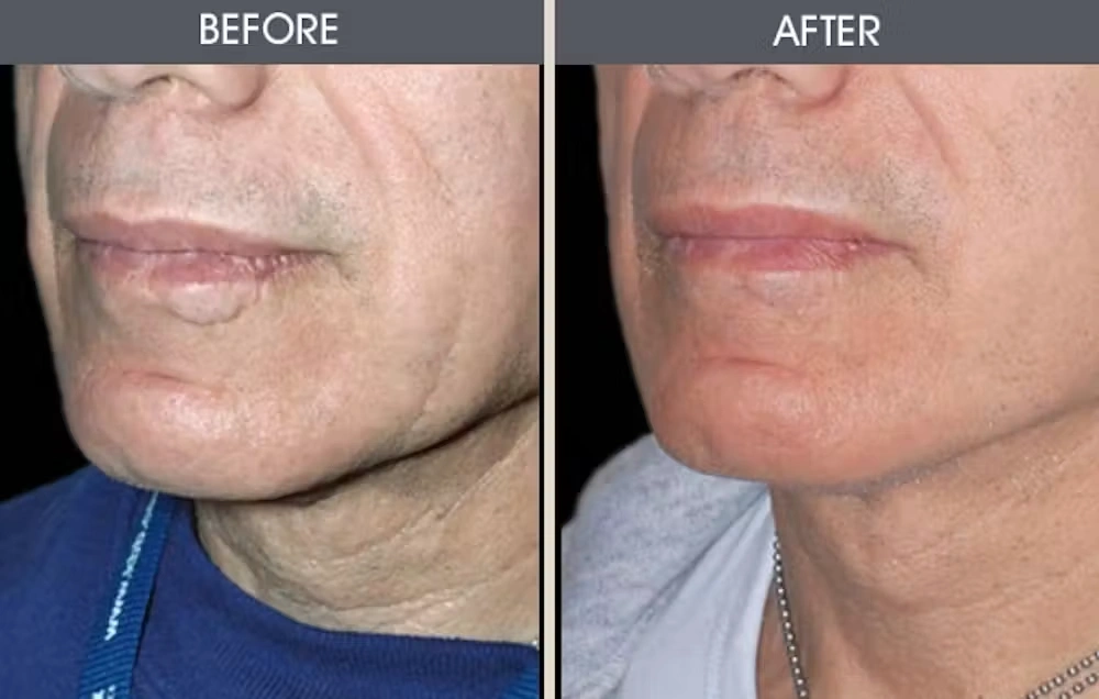 Real patient results in New York, NY Performed by Darrick E. Antell MD, FACS