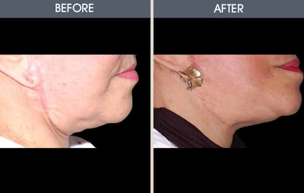 Real patient results in New York, NY Performed by Darrick E. Antell MD, FACS