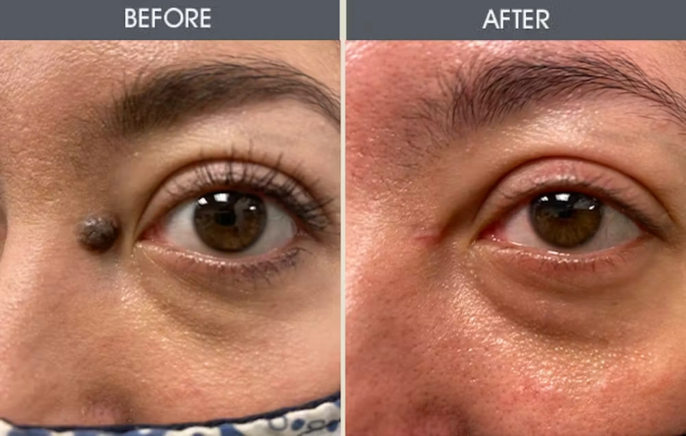Real patient results in New York, NY Performed by Darrick E. Antell MD, FACS