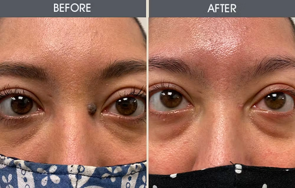 Real patient results in New York, NY Performed by Darrick E. Antell MD, FACS