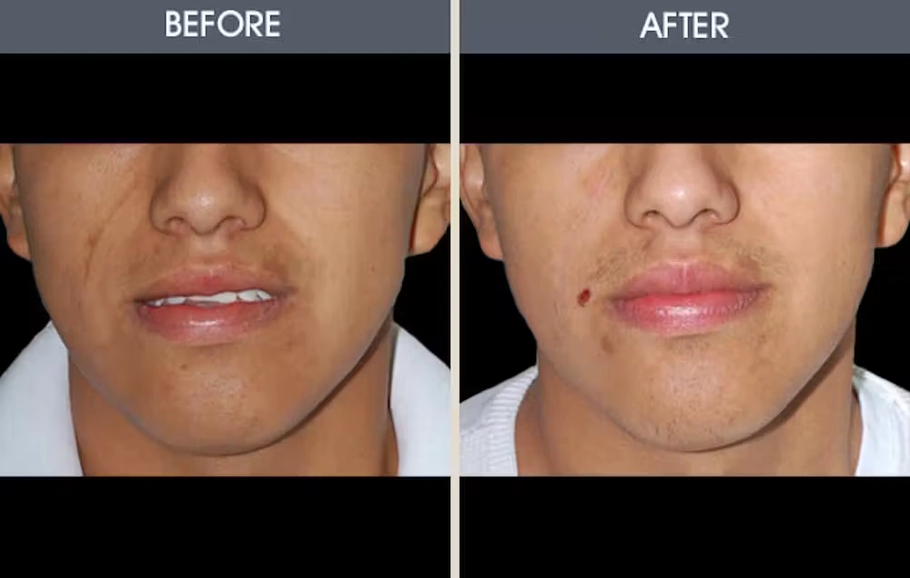 Real patient results in New York, NY Performed by Darrick E. Antell MD, FACS