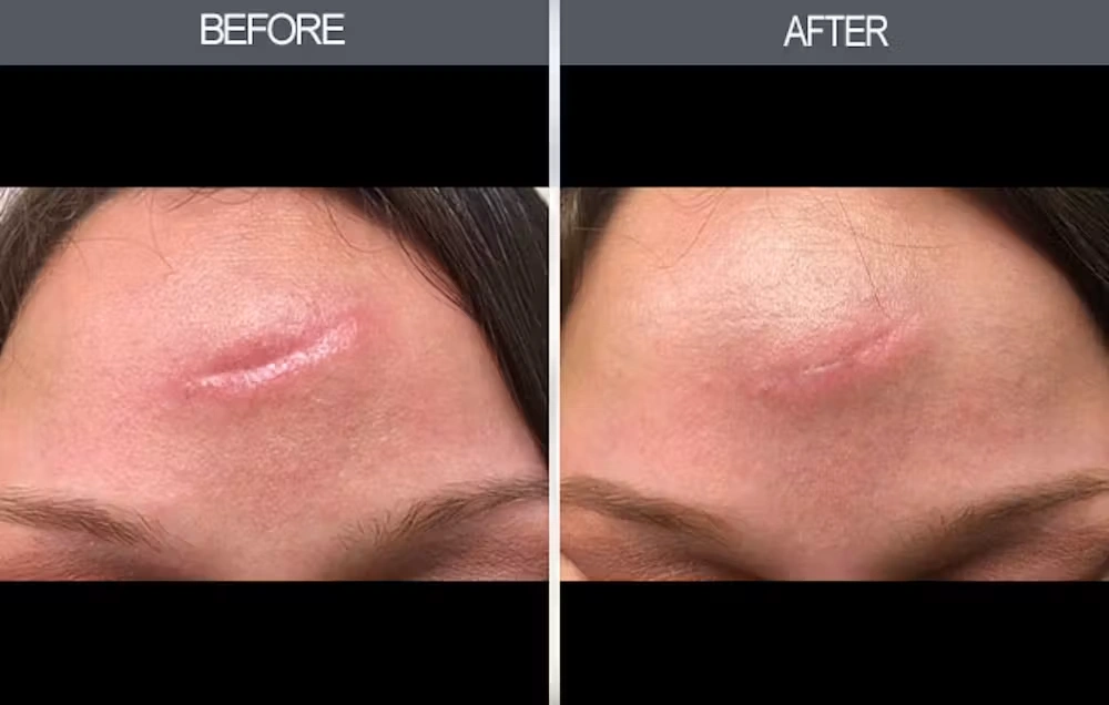 Real patient results in New York, NY Performed by Darrick E. Antell MD, FACS