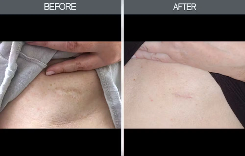 Real patient results in New York, NY Performed by Darrick E. Antell MD, FACS