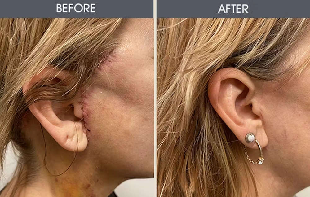 Real patient results in New York, NY Performed by Darrick E. Antell MD, FACS