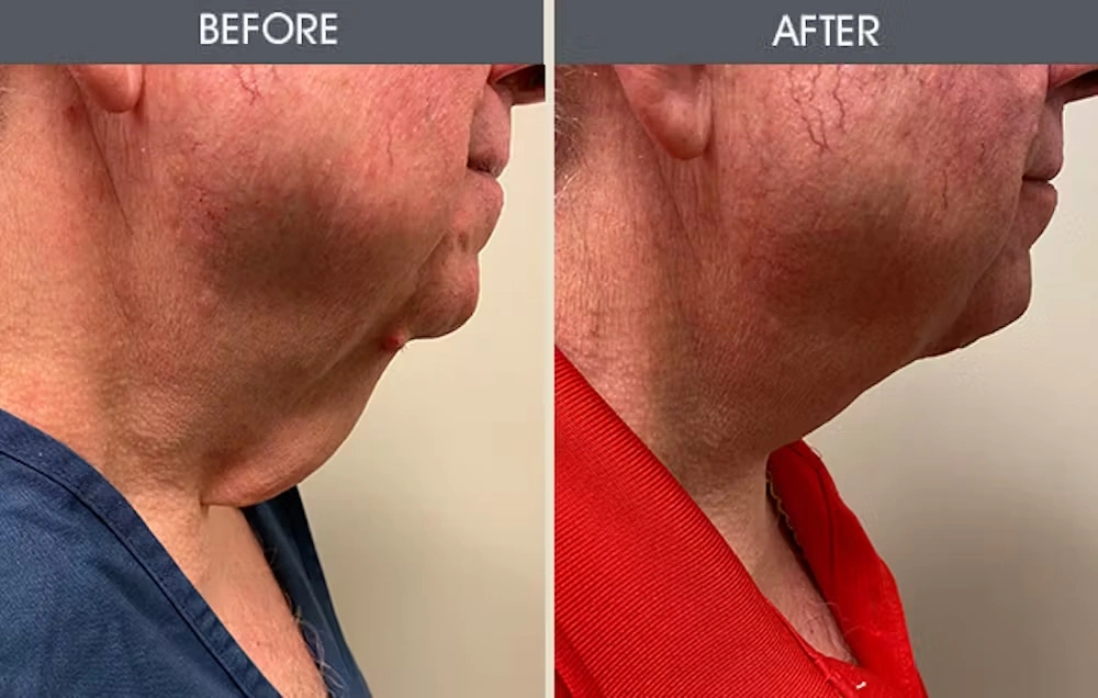 Real patient results in New York, NY Performed by Darrick E. Antell MD, FACS