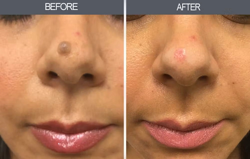 Real patient results in New York, NY Performed by Darrick E. Antell MD, FACS