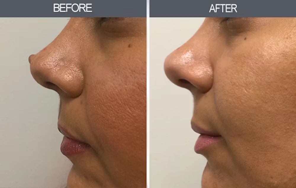 Real patient results in New York, NY Performed by Darrick E. Antell MD, FACS