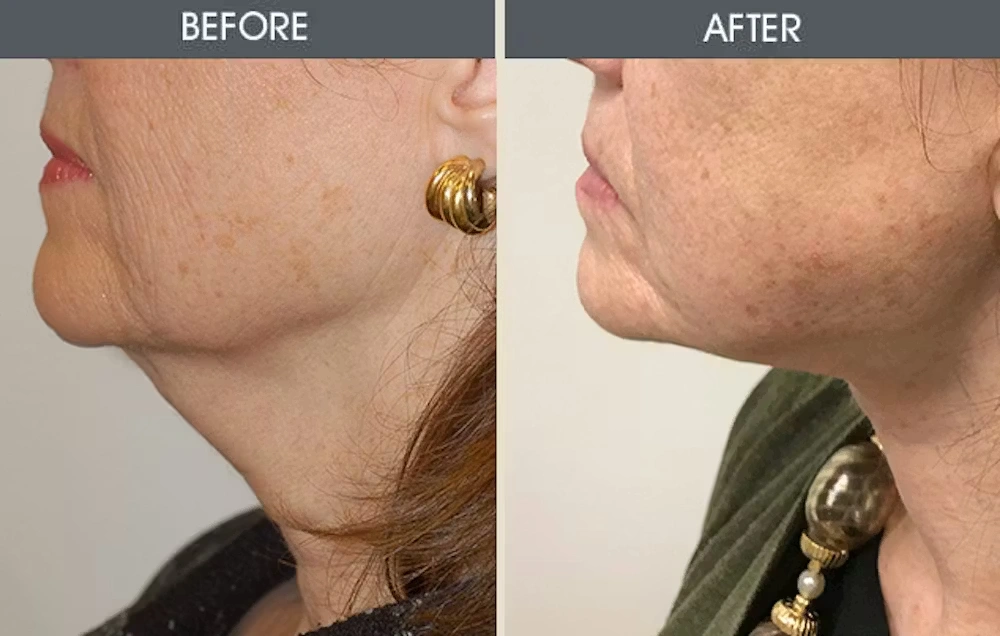 Real patient results in New York, NY Performed by Darrick E. Antell MD, FACS