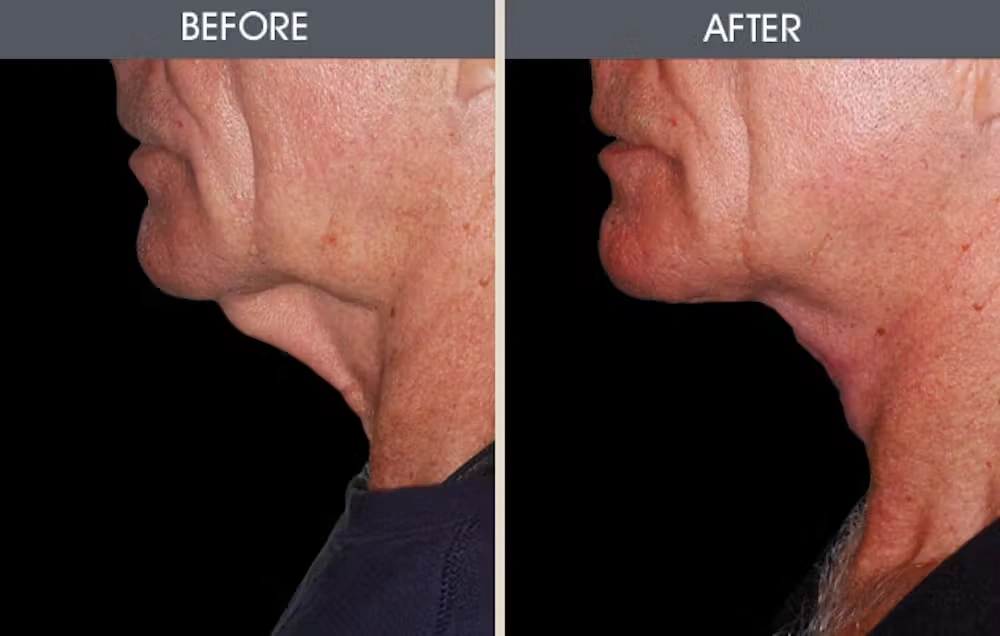 Real patient results in New York, NY Performed by Darrick E. Antell MD, FACS